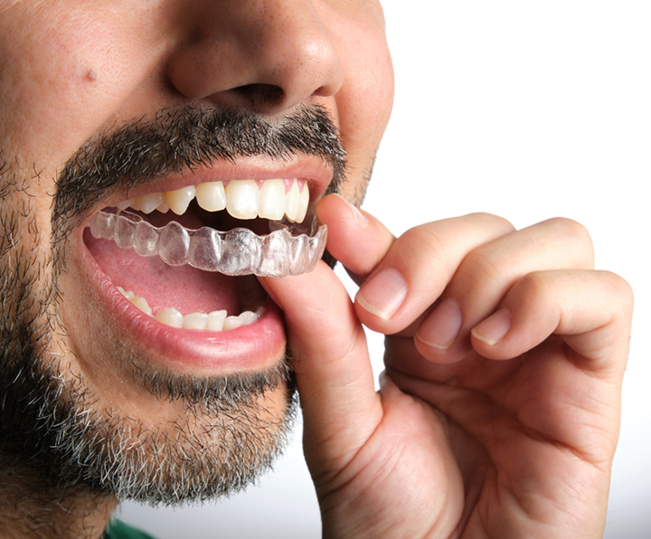 Close Up Of Man Inserting Clear Aligner Into Mouth