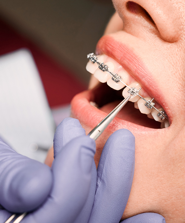 Close Up Of Orthodontist Examining Patients Teeth With Braces