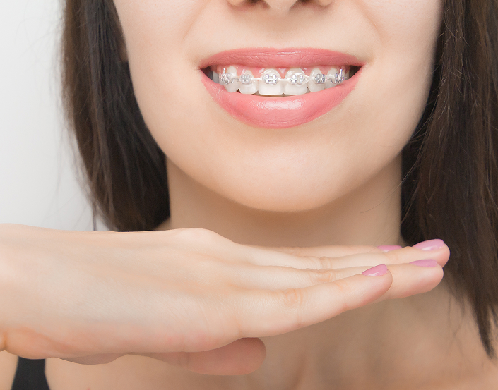 Close Up Of Woman Wearing Braces With Her Hand Beneath Her Chin
