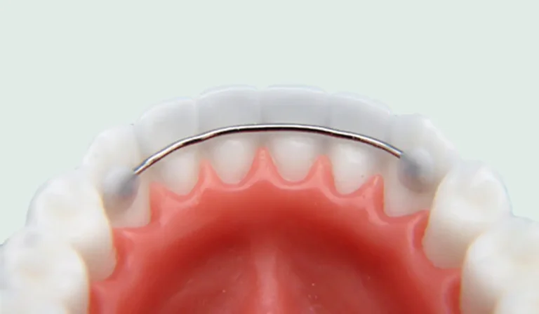 Close Up Of Bonded Retainers