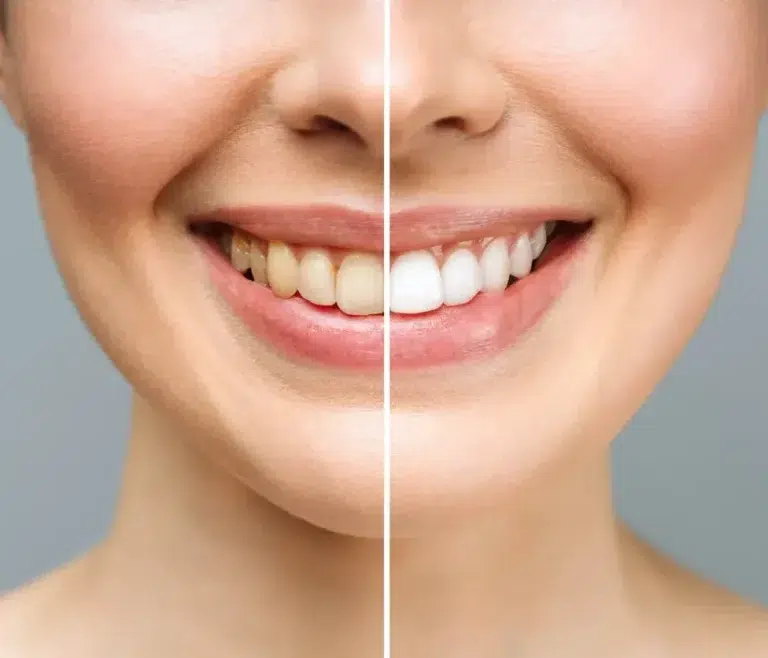 Teeth whitening before and after