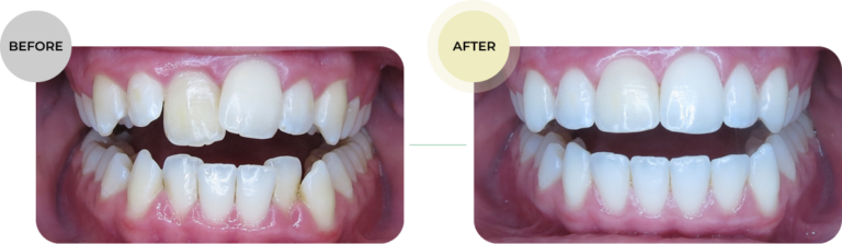 Before After 3